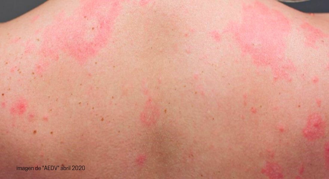 Afectaciones COVID-19 en la piel