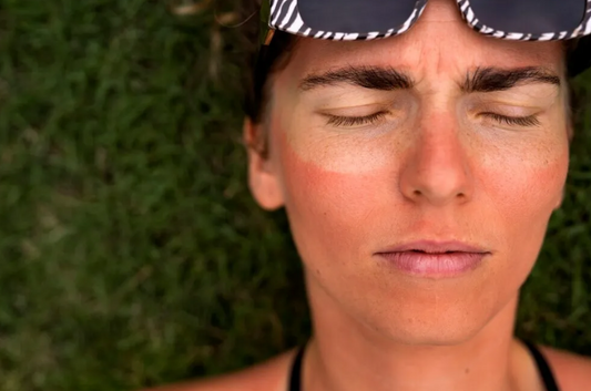 ¿Quemaduras solares? GGcare te ayuda a paliar sus efectos