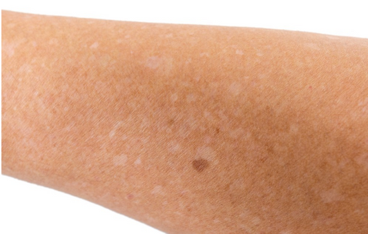 Cómo combatir las manchas en la piel