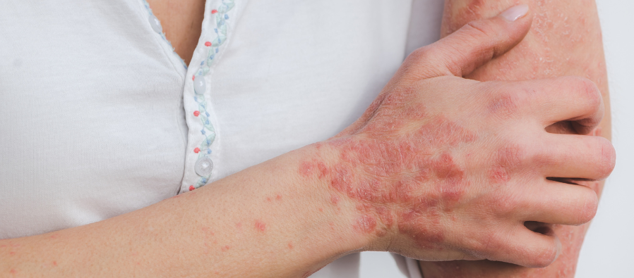 El impacto de la psoriasis en nuestro bienestar